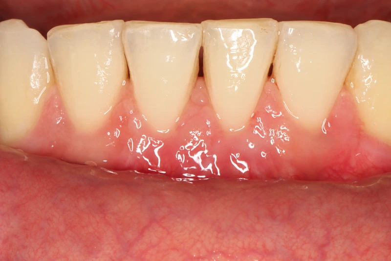 Lower front teeth and gums six months after gum grafting at teeth 24 and 25.