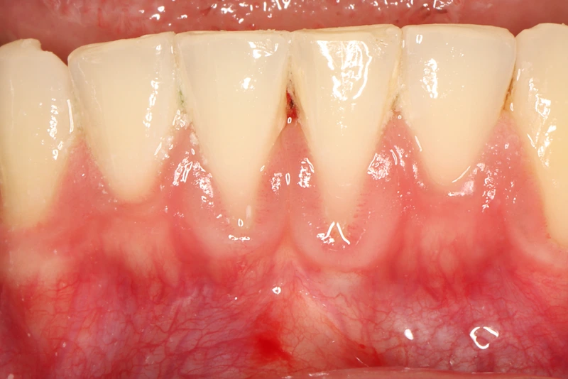 Lower front teeth and gums before gum grafting at teeth 24 and 25.