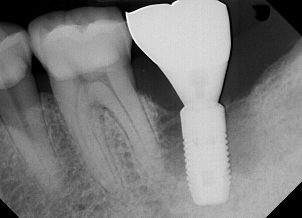 Dental X-ray before treatment of peri-implantitis, showing the implant and surrounding bone.