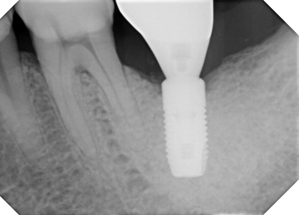 Dental X-ray of the same implant and surrounding bone at five-year follow-up after peri-implantitis treatment.